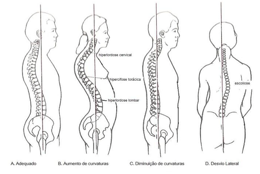 Qual a diferença entre escoliose e má postura?